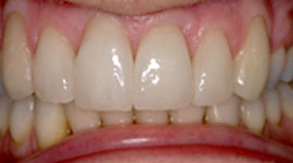 After porcelain veneers