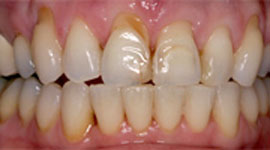 Before porcelain veneers