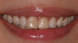 Before porcelain veneers treatment