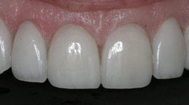 After veneers