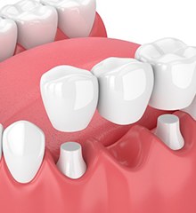 a 3D illustration of a dental bridge