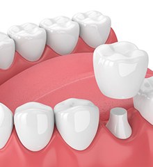a 3D illustration of a dental crown