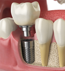 3D image of an implant in the lower jaw