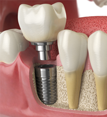 3D image of an implant in the lower jaw
