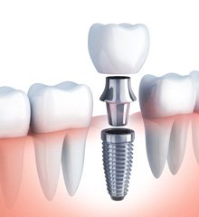 two dental implants on a blue background