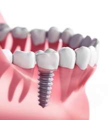 3D illustration of dental implant