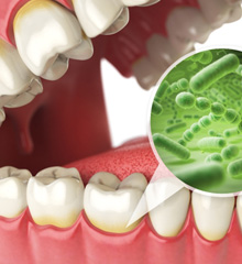 Illustration of bacteria on model of teeth