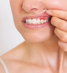 Closeup of patient with red, inflamed gums