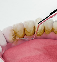 Illustration of teeth cleaning