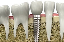 Illustration of dental implant