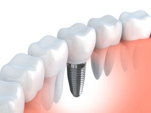 Farmington Dental Implants