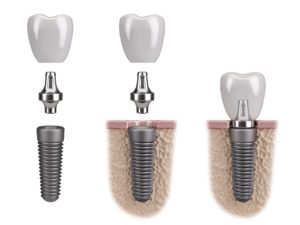 parts of a dental implant