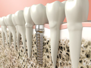 Model of an implant in a lower jaw  