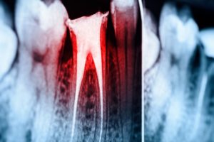 X-ray of an infected tooth