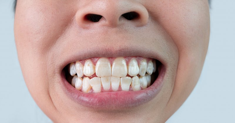 Close-up of smile with white spots of teeth